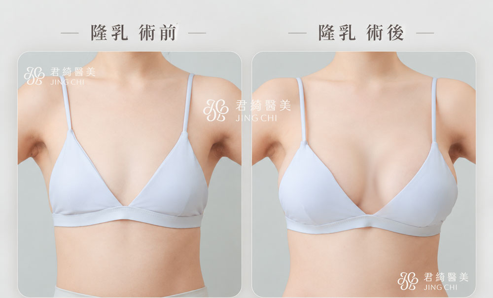 隆乳術前術後