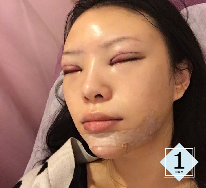 下巴雙眼皮手術