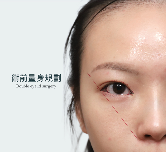 下巴雙眼皮手術