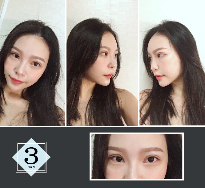 下巴雙眼皮手術