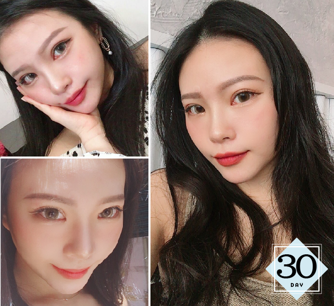 下巴雙眼皮手術