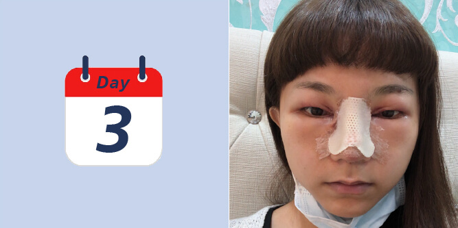 SURGERY x DAY.3 術後第三天